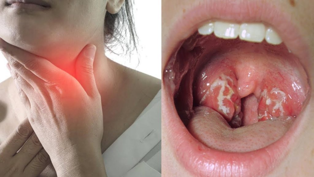 Tonsillitis Treatment