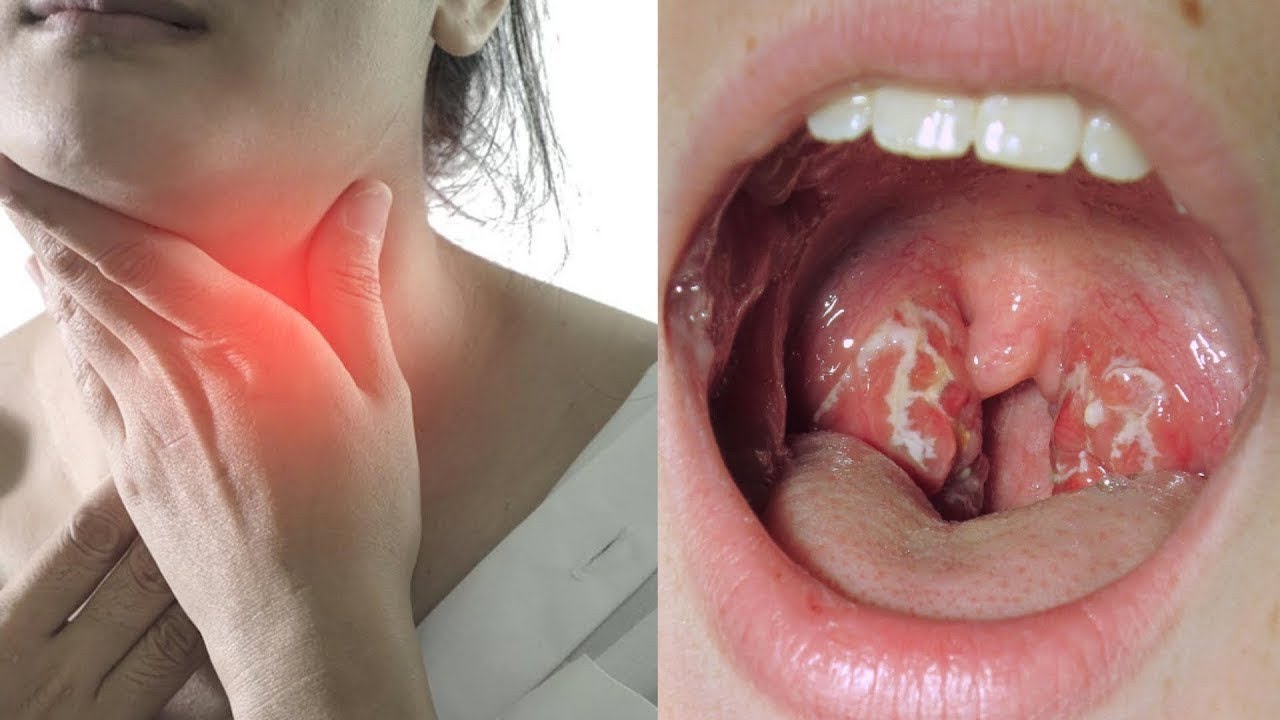 Tonsillitis Treatment