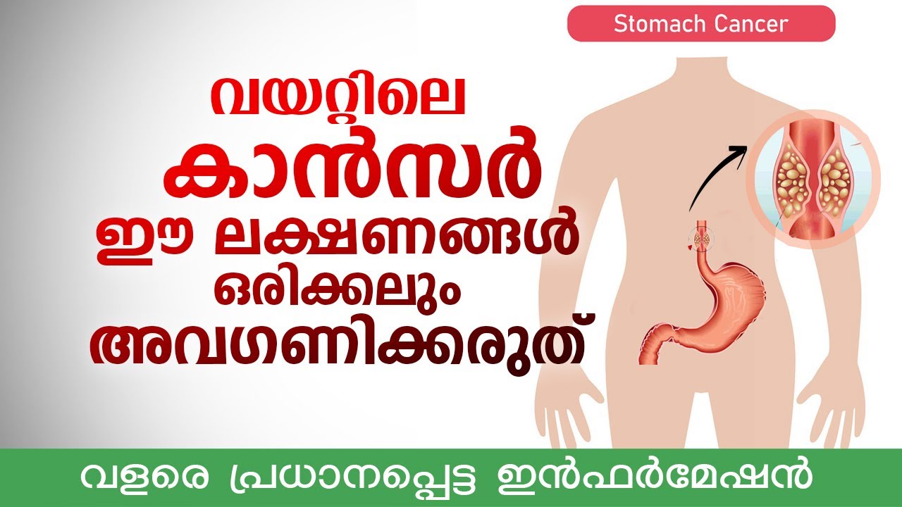 Stomach cancer early symptoms