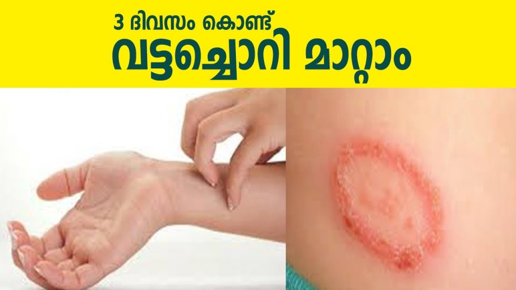 Home remedy for Ringworm