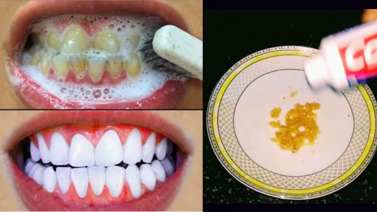 Teeth can be whitened