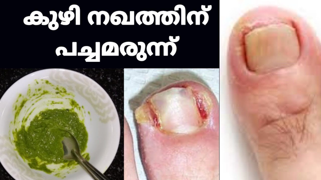 Toenail Fungus Treatment