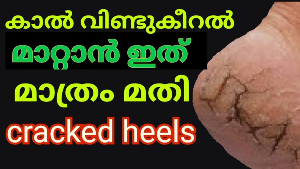 Cracked heels home remedy